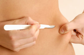 La abdominoplastia, una técnica revolucionaria para perder barriga