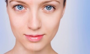 Cómo disimular el acné con maquillaje