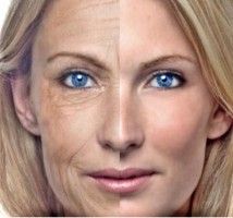 Arrugas y lipofilling