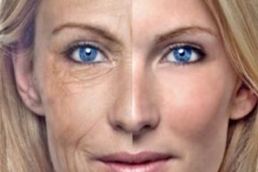 El lipofilling para corregir las imperfecciones del rostro