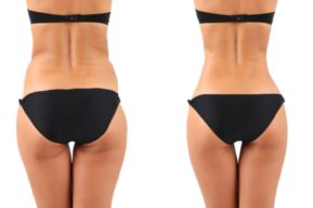 Liposucción e Índice de Masa Corporal