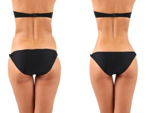 Liposucción e Índice de Masa Corporal Liposucción e Índice de Masa Corporal