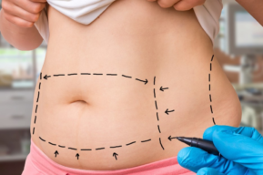 Liposucción y lipoescultura, aliados de la belleza